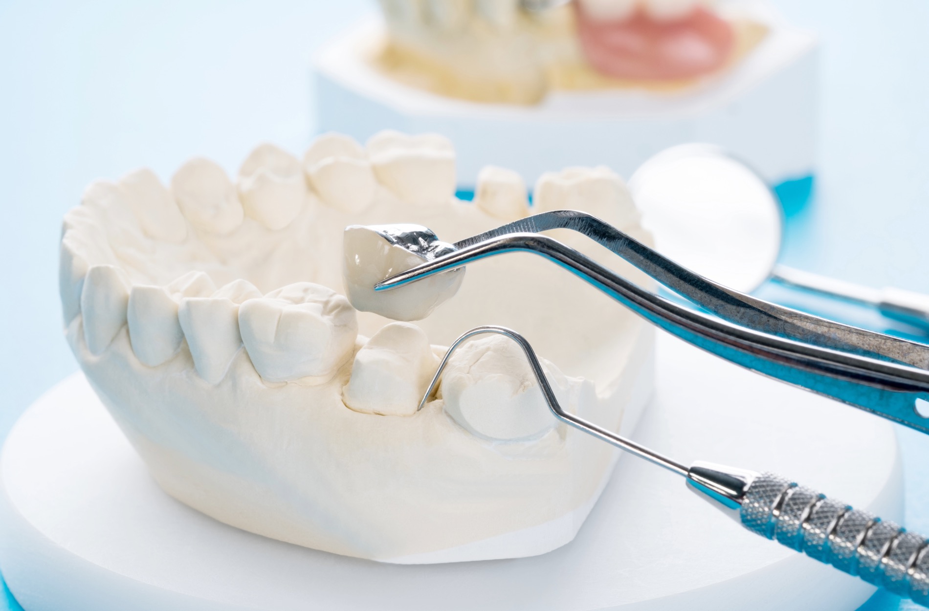 How to Care for Dental Crowns and Veneers